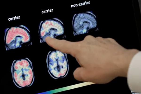 Alzheimer’ı yavaşlatacak ilk ilaç yolda