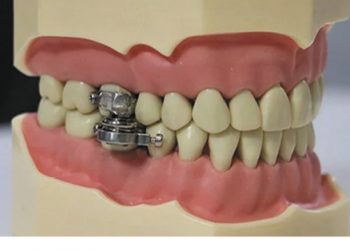 Obeziteye çare; çene kilidi