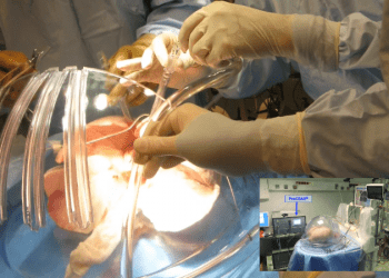 Organ naklinde çığır açacak gelişme