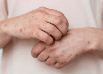 Enfield’de kızamık salgını: Yetkililer sakinleri aşı kontrolüne çağırdı